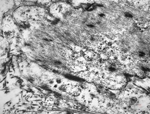 M,52y. | myofibroblastic tumor - pleura